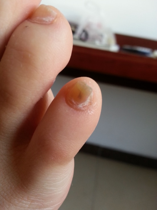 《灰指甲：成因、症状和养生护理，告别指甲困扰 ｜ 百草香灸吸好了就不吸了，百草香灸是哪个公司的产品？》