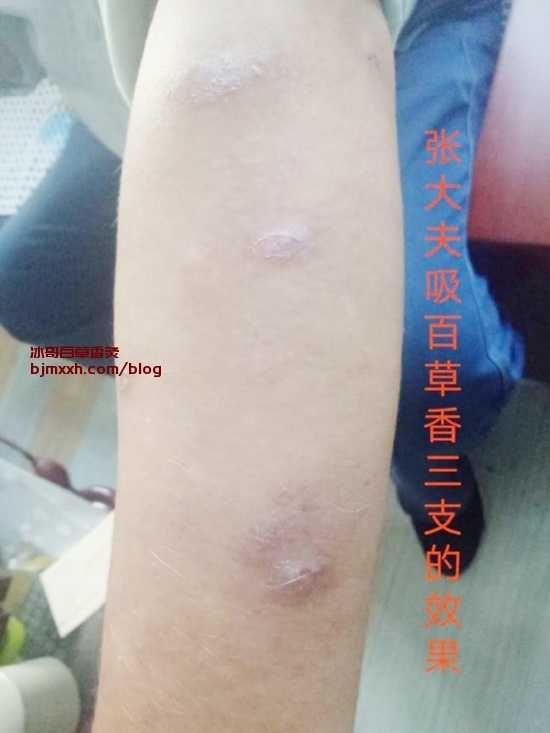 《千万别错过的“早”之重要性！ | 百草香灸能治疗什么病，新百草香灸的好坏怎么判断？》