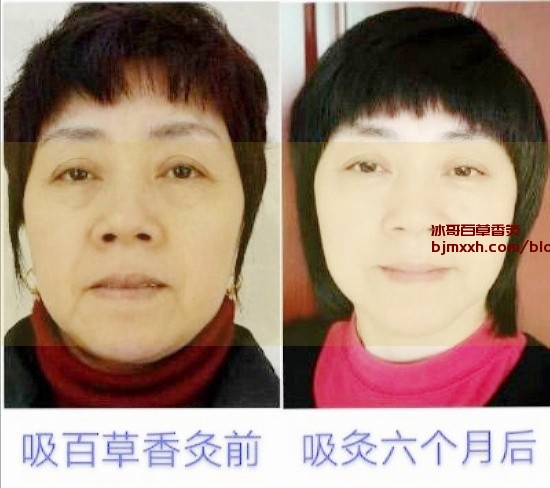 《防止微笑线：吃出健康肌肤的秘诀 | 百草香灸模式，百草香灸治疗脚气吗？》