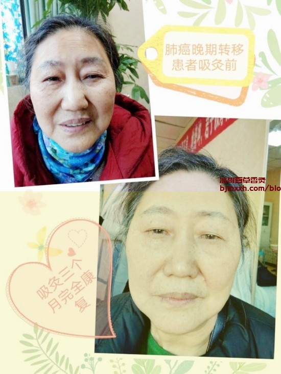 《不墨守陈规，养生就要新潮玩出花样！ | 百草香灸制做方法，百草香灸能治疗痔疮吗？》